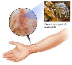 Scabies Home Remedy